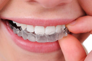 Aligners