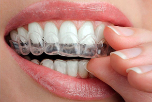 Tooth Whitening